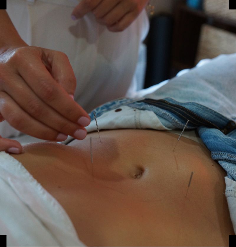 Acupuncture