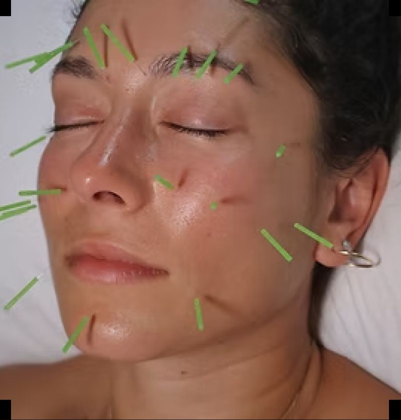 Cosmetic Acupuncture