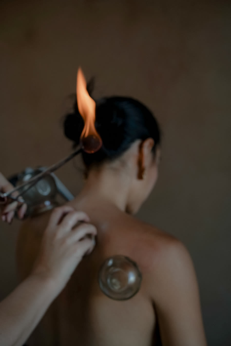 Fire cupping on the upper back