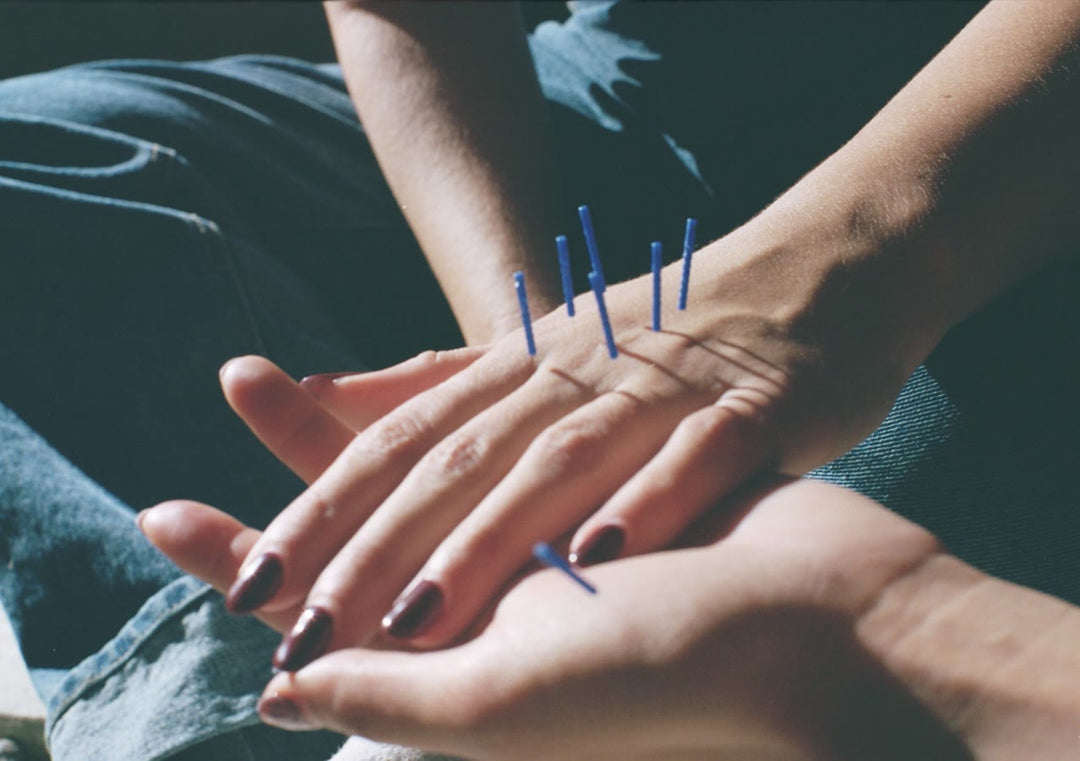 Acupuncture needles in the hand