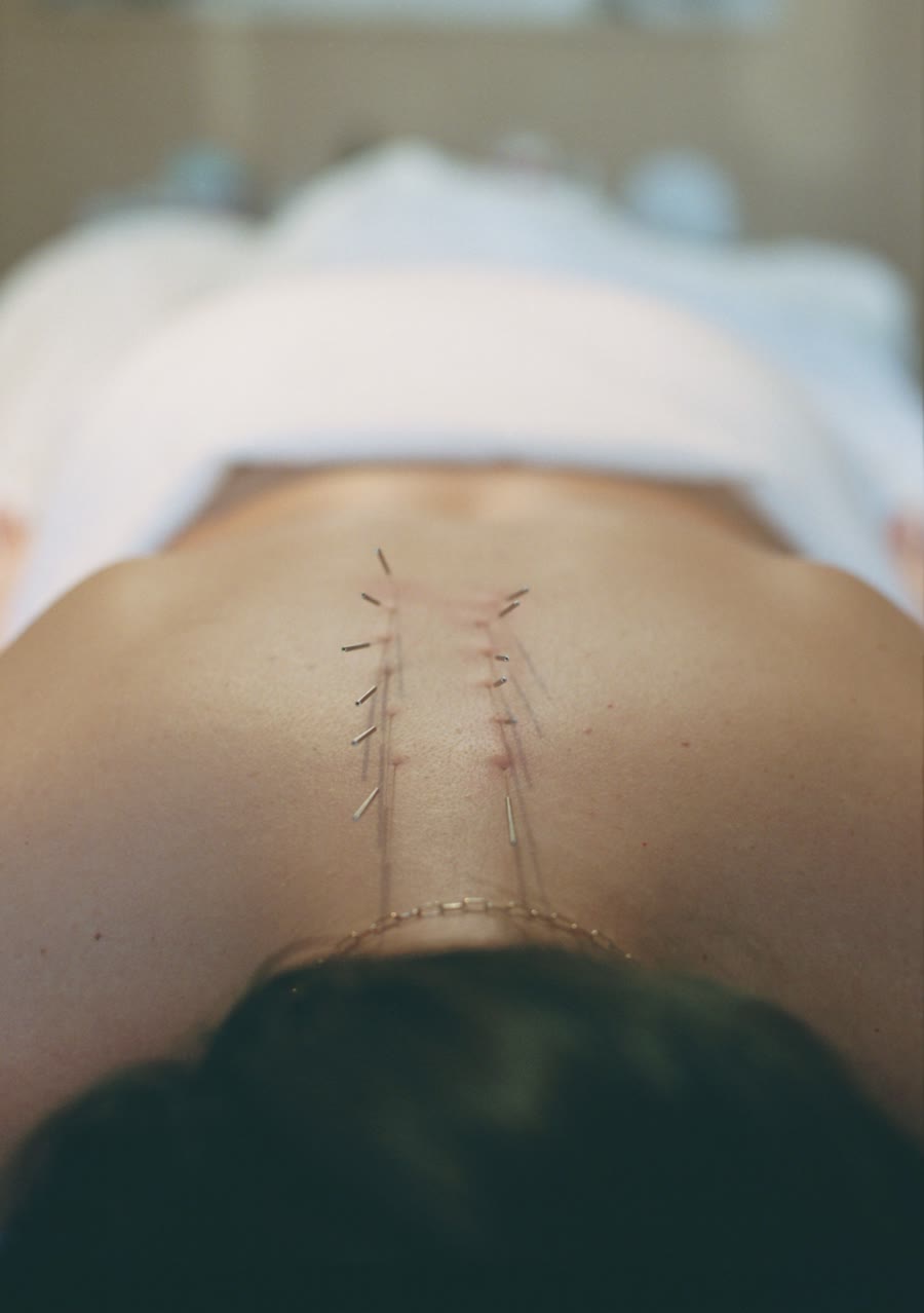 Acupuncture needles along the spine