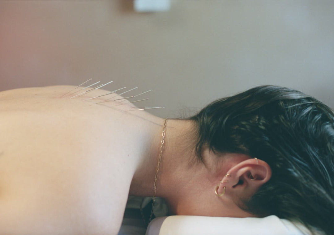 Acupuncture needles along the neck and shoulders