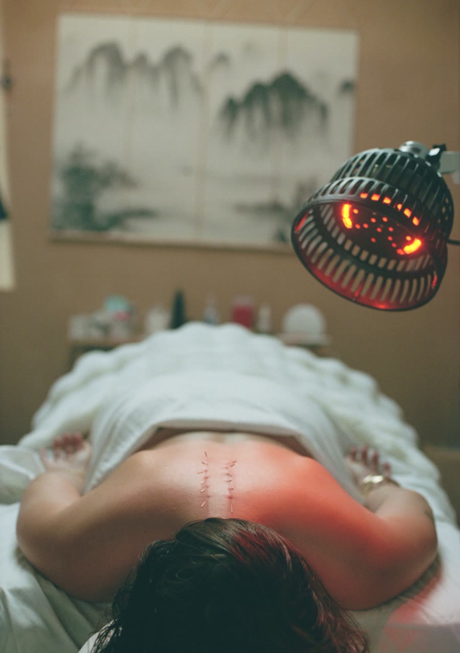 A patient resting under the heat lamp with needles along the spine