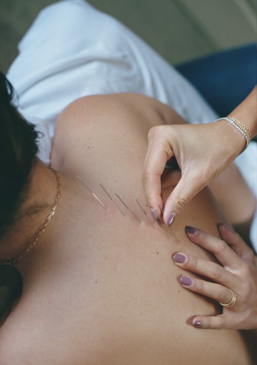 A practitioner placing a needle on the shoulder
