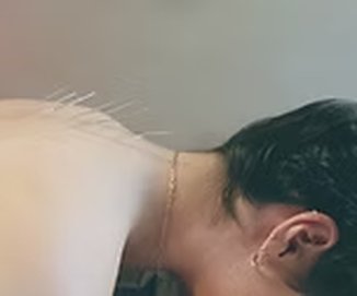 Acupuncture