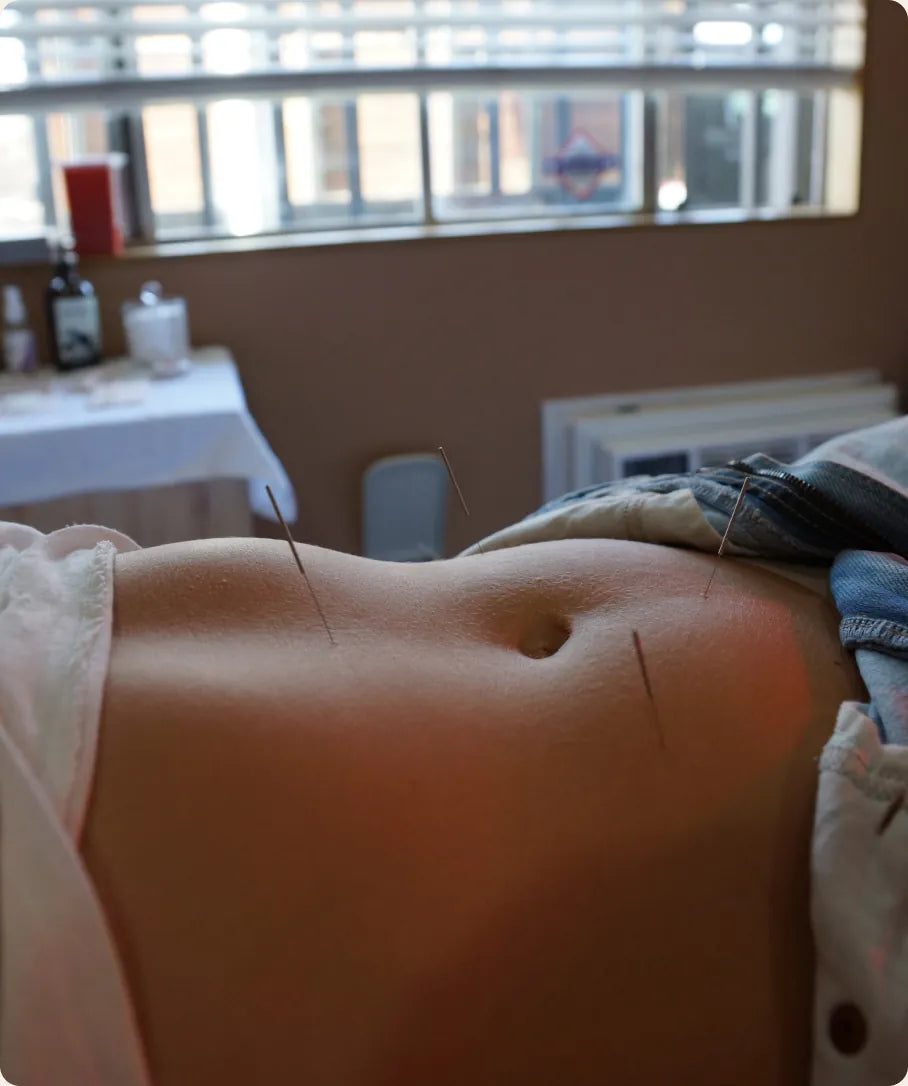 Acupuncture needles placed along a patient's abdomen